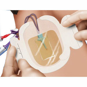 3M Tegaderm CHG Chlorhexidine Gluconate IV Securement Dressing, Waterproof, Sterile, Latex-Free 3-1/2" x 4-1/2"
